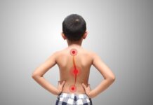 5 Things You Need To Know About Scoliosis