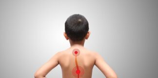 5 Things You Need To Know About Scoliosis