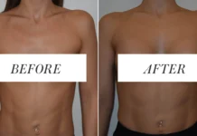 What You Need to Know Before Getting a Body Enhancement Procedure