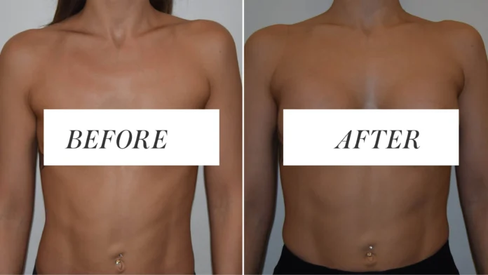 What You Need to Know Before Getting a Body Enhancement Procedure