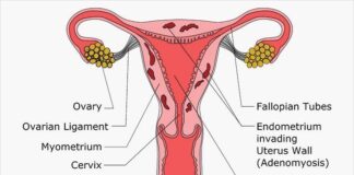 Do I Need Treatment for Silent Endometriosis