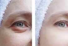 How Many Times Can You Do Droopy Eyelid Surgery (Blepharoplasty)