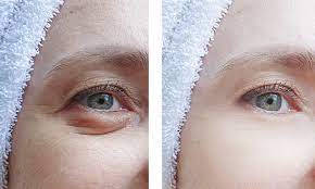 How Many Times Can You Do Droopy Eyelid Surgery (Blepharoplasty)