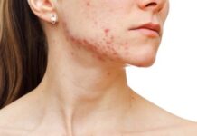 Understanding the Different Stages of Acne