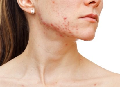 Understanding the Different Stages of Acne