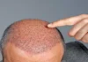Hair transplant treatments by an experienced and expert hair surgeon