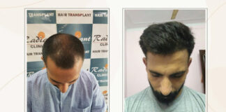Radiant Skin clinic quickly becoming the number 1 hair transplant clinic